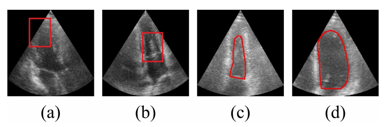 图 1. 超声心动图视频分割的挑战：（a）轮廓模糊，（b）斑点噪声，以及（c-d）跨帧（同一视频的两帧）的比例变化。