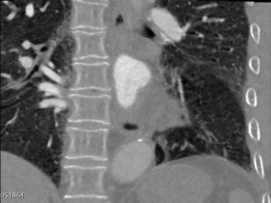 CT数据集分类实验