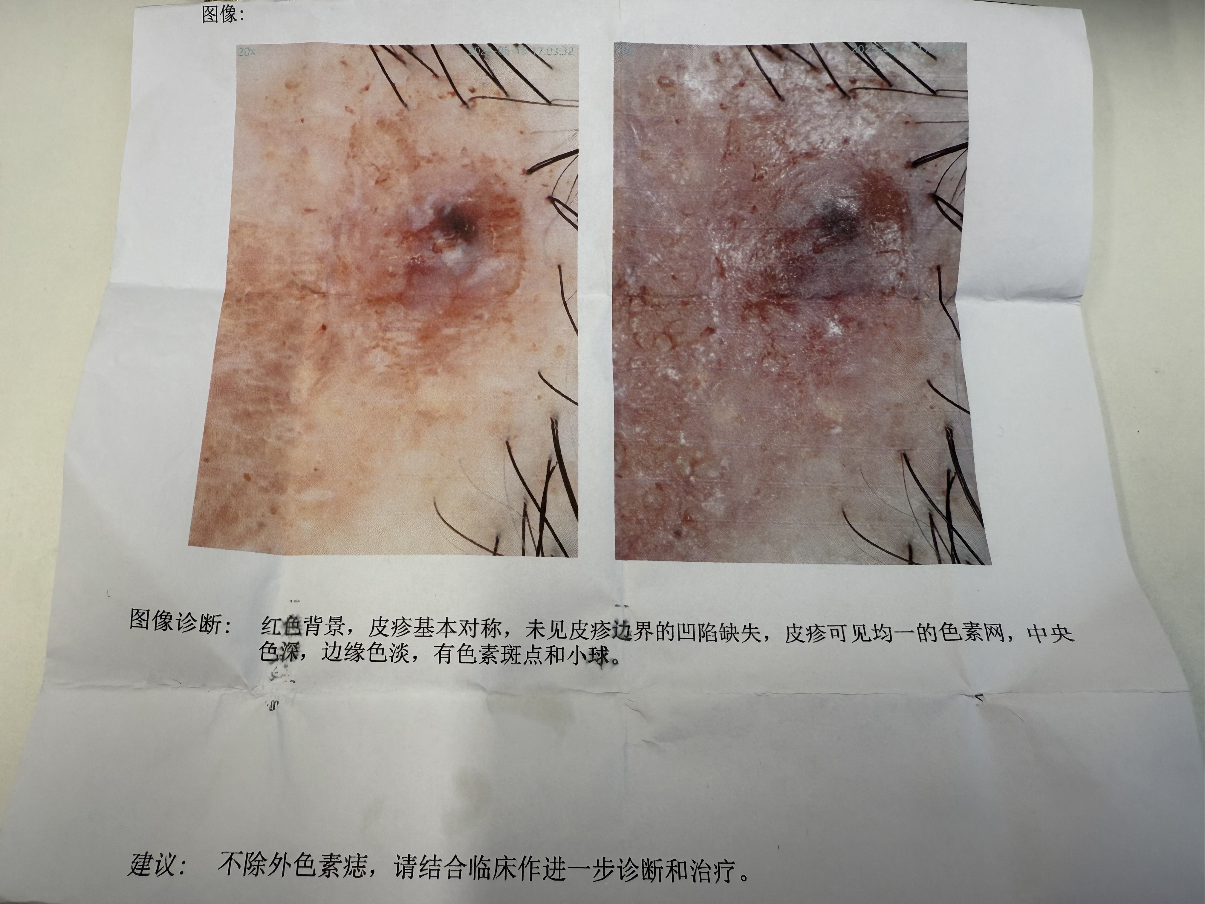 皮肤镜检查报告单