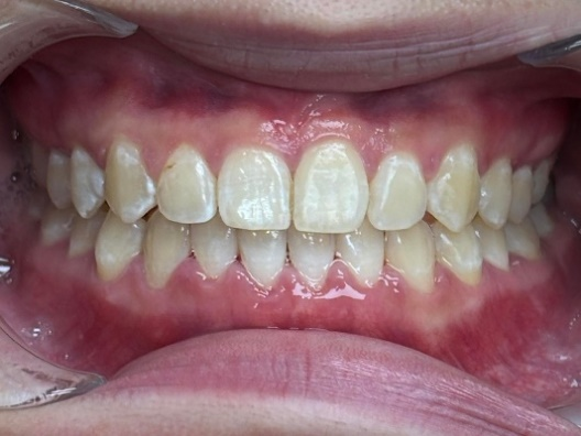 After Treatment - Patient 1