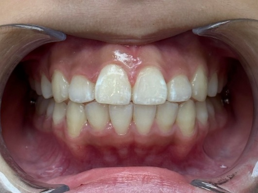 After Treatment - Patient 2