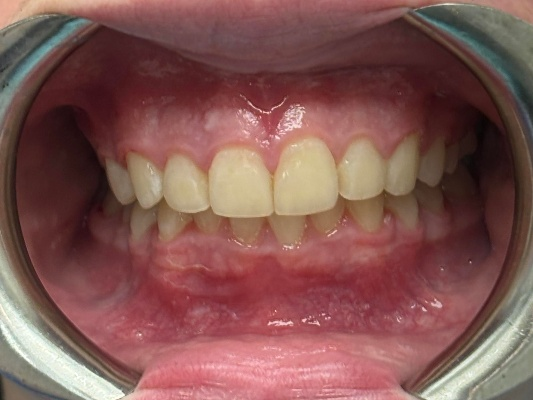 After Treatment - Patient 3