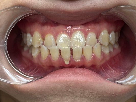 Before Treatment - Patient 1