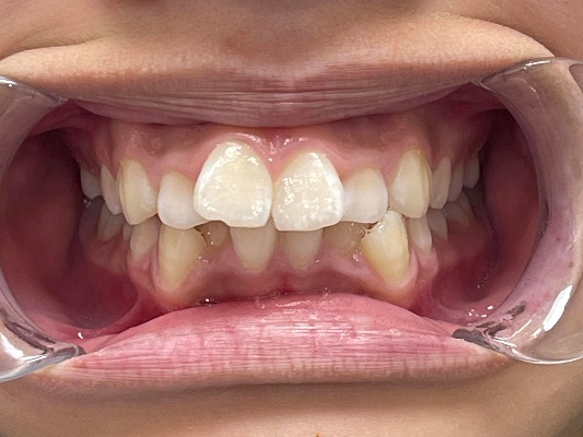 Before Treatment - Patient 2