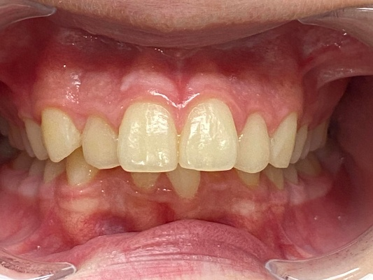 Before Treatment - Patient 3