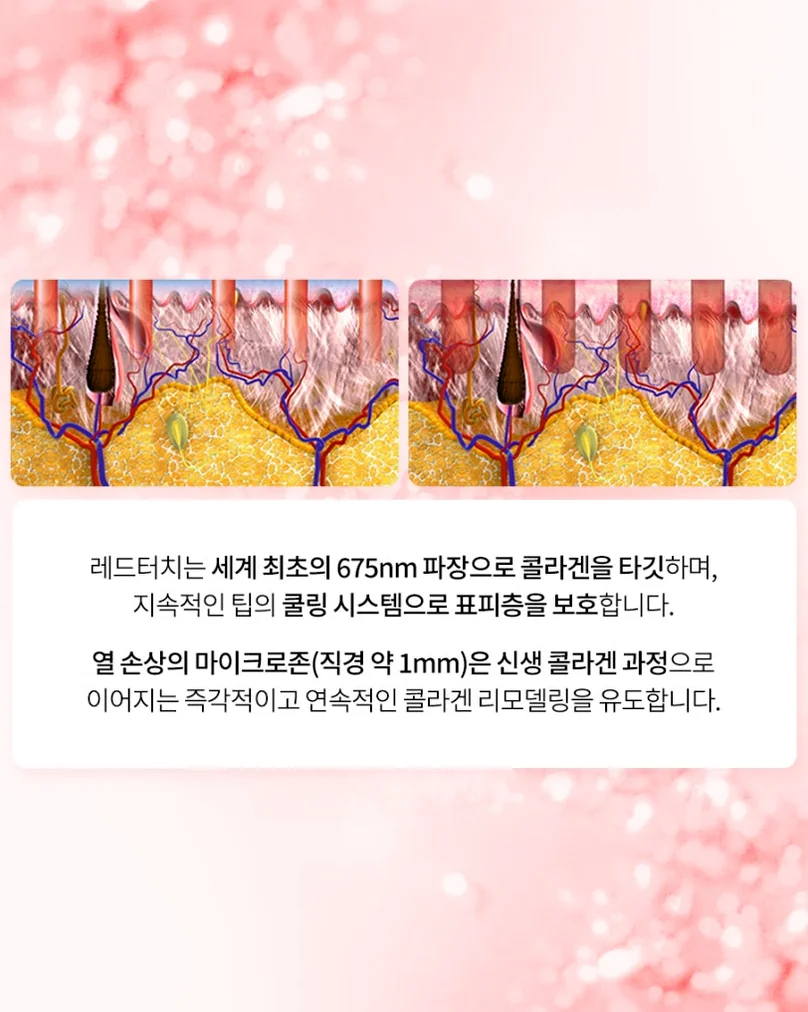 施術後の肌内部でコラーゲンが再生される過程を視覚化した教育用データ - 2026年、ソウルの美意識が選ぶ「レッドタッチ・プロ」。コラーゲンを呼び覚ます、次世代の肌管理