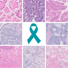 Logo for UBC Ovarian Cancer Subtype Classification and Outlier Detection (UBC-OCEAN)