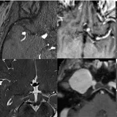 Logo for RSNA Intracranial Aneurysm Detection