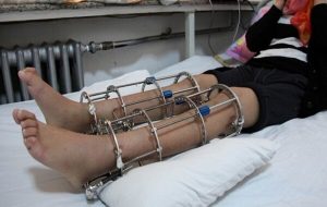 جراحی افزایش قد؛ معجزه یا شکنجه مدرن؟