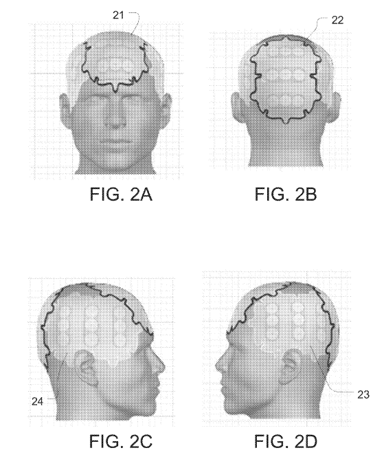 图2A至2D描绘了用于治疗脑肿瘤的电极阵列在人的头部上的定位。