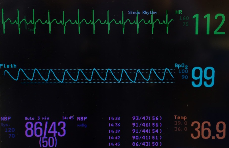 pulseoximeter