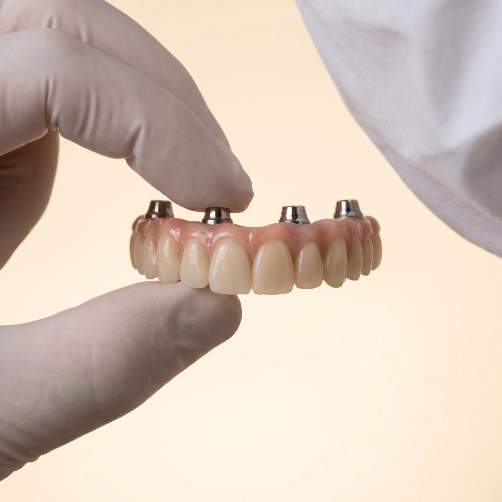 Festsitzende Brücke auf sechs Titan-Implantaten