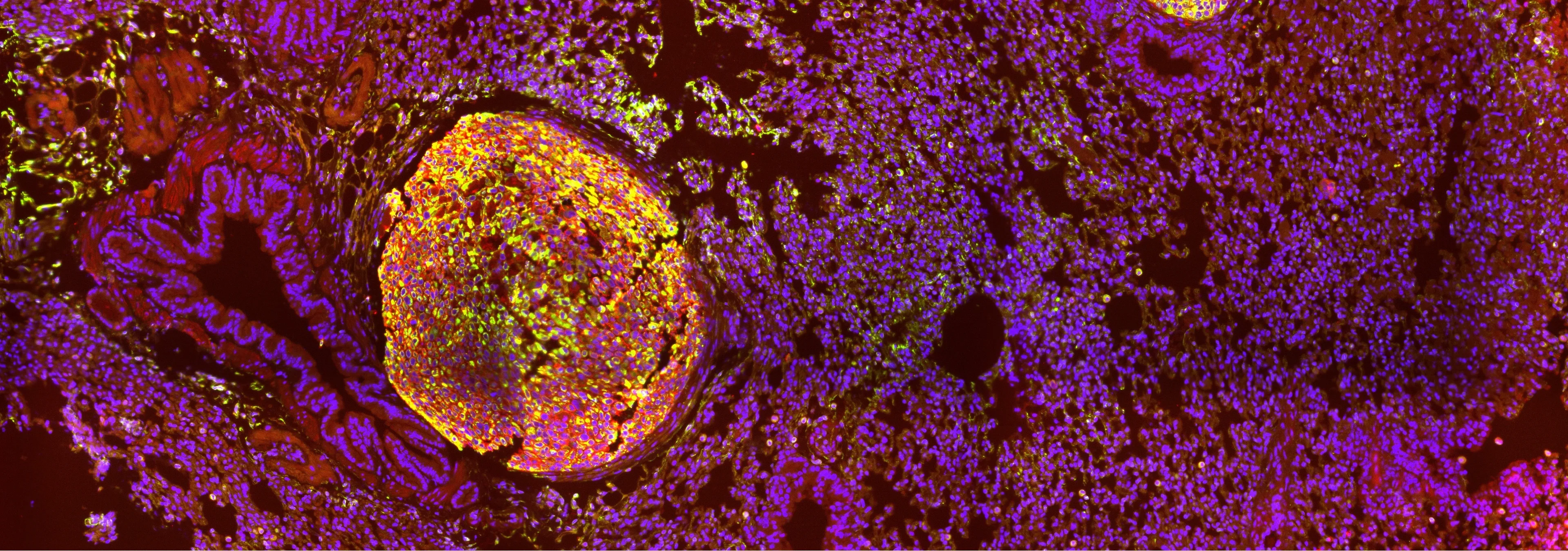 Multiplexed imaging of lung tissue with metastasis