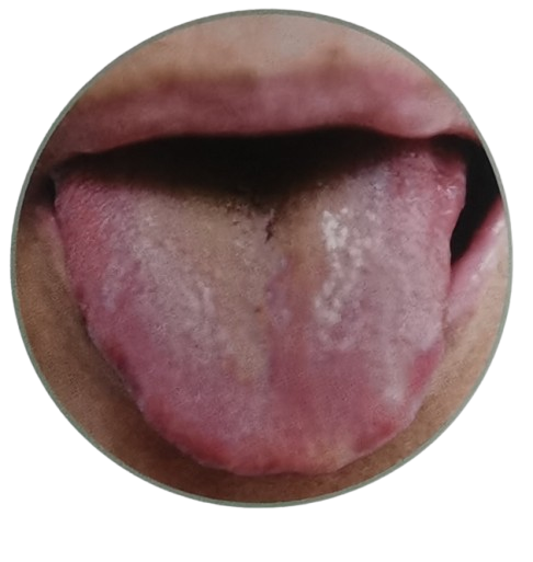 8 Clear Signs of Phlegm Dampness in Chinese Tongue Diagnosis - Bright Purple Tongue with Thick Greasy Coating