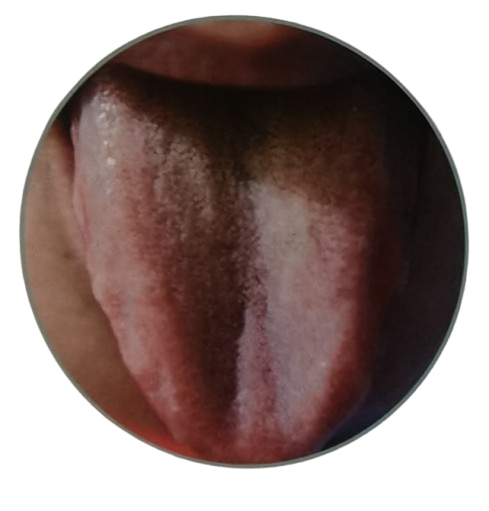 8 Clear Signs of Phlegm Dampness in Chinese Tongue Diagnosis - Dark red tongue with thin yellow greasy coating.