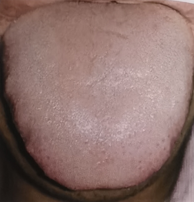 8 Clear Signs of Phlegm Dampness in Chinese Tongue Diagnosis - Fat, enlarged tongue with tooth marks and a white, greasy coating.