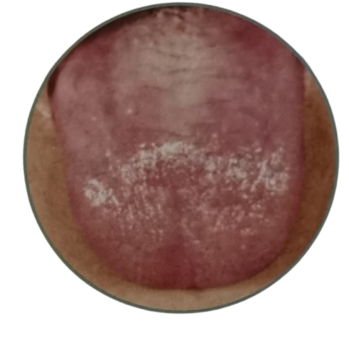 8 Clear Signs of Phlegm Dampness in Chinese Tongue Diagnosis - Dark Purple Tongue with Blood Stasis Spots
