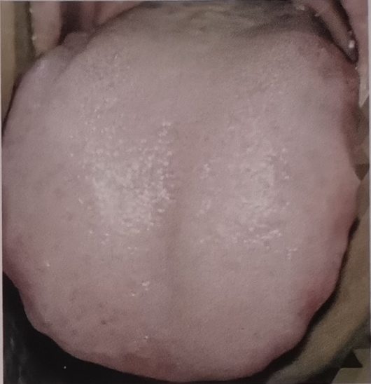 8 Clear Signs of Phlegm Dampness in Chinese Tongue Diagnosis - Fat tongue with pale color, white greasy coating, and tooth marks along the edges.