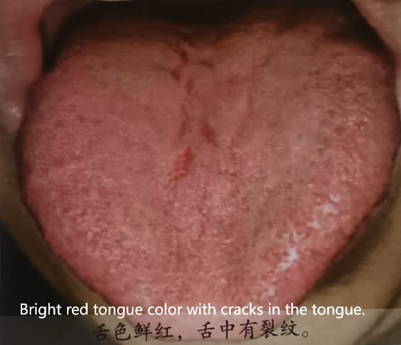 Traditional Chinese Medicine Tongue Diagnosis: How to Determine Health Through Tongue Color