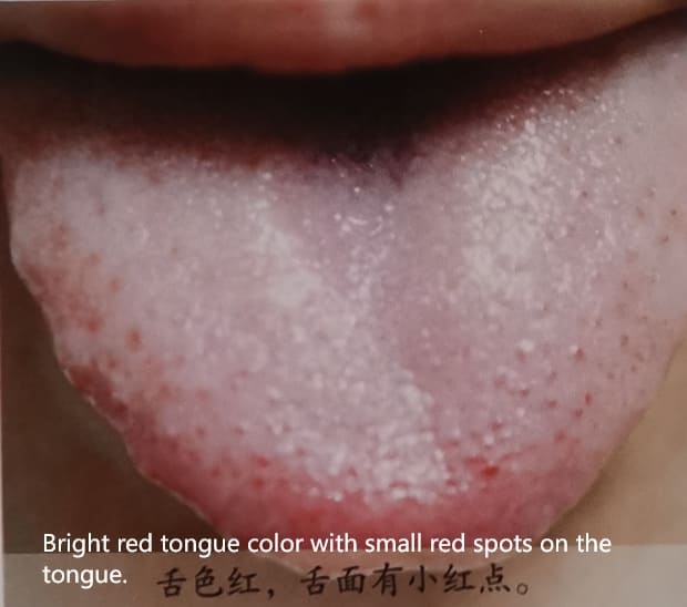 Traditional Chinese Medicine Tongue Diagnosis: How to Determine Health Through Tongue Color