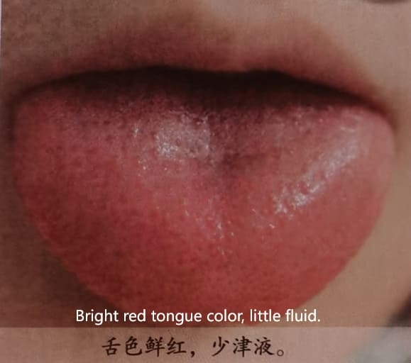 Traditional Chinese Medicine Tongue Diagnosis: How to Determine Health Through Tongue Color