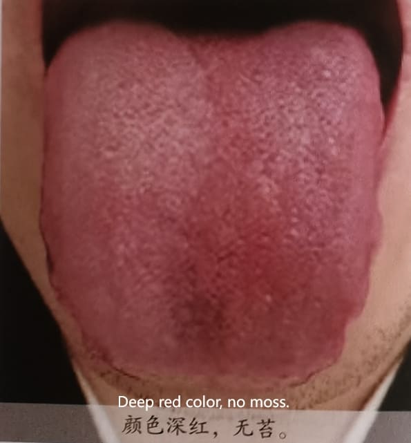 Traditional Chinese Medicine Tongue Diagnosis: How to Determine Health Through Tongue Color