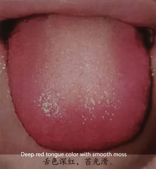 Traditional Chinese Medicine Tongue Diagnosis: How to Determine Health Through Tongue Color