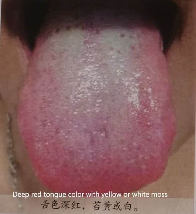 Traditional Chinese Medicine Tongue Diagnosis: How to Determine Health Through Tongue Color