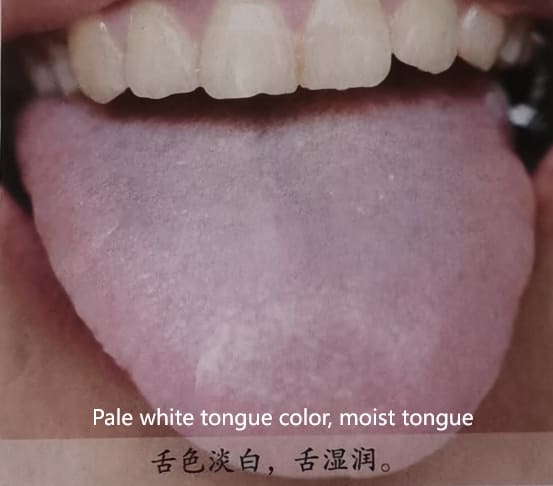 Traditional Chinese Medicine Tongue Diagnosis: How to Determine Health Through Tongue Color
