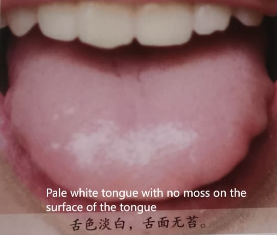 Traditional Chinese Medicine Tongue Diagnosis: How to Determine Health Through Tongue Color