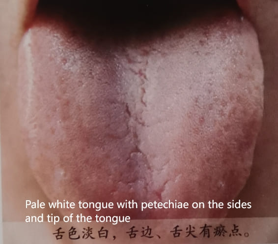 Traditional Chinese Medicine Tongue Diagnosis: How to Determine Health Through Tongue Color