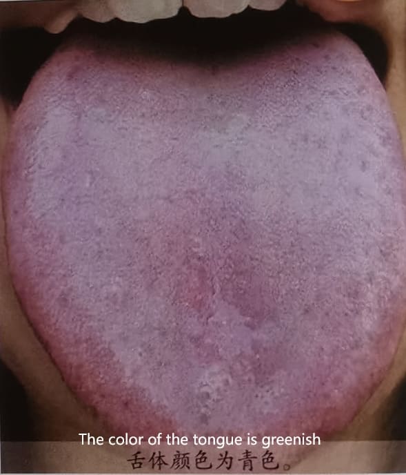 Traditional Chinese Medicine Tongue Diagnosis: How to Determine Health Through Tongue Color