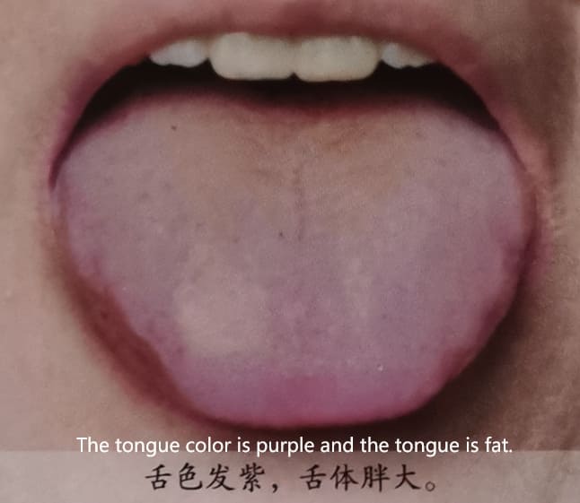 Traditional Chinese Medicine Tongue Diagnosis: How to Determine Health Through Tongue Color