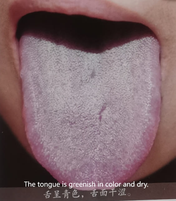Traditional Chinese Medicine Tongue Diagnosis: How to Determine Health Through Tongue Color
