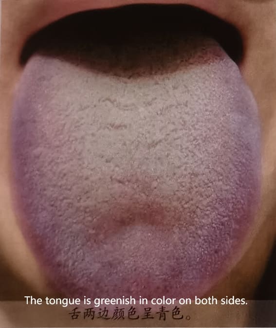 Traditional Chinese Medicine Tongue Diagnosis: How to Determine Health Through Tongue Color
