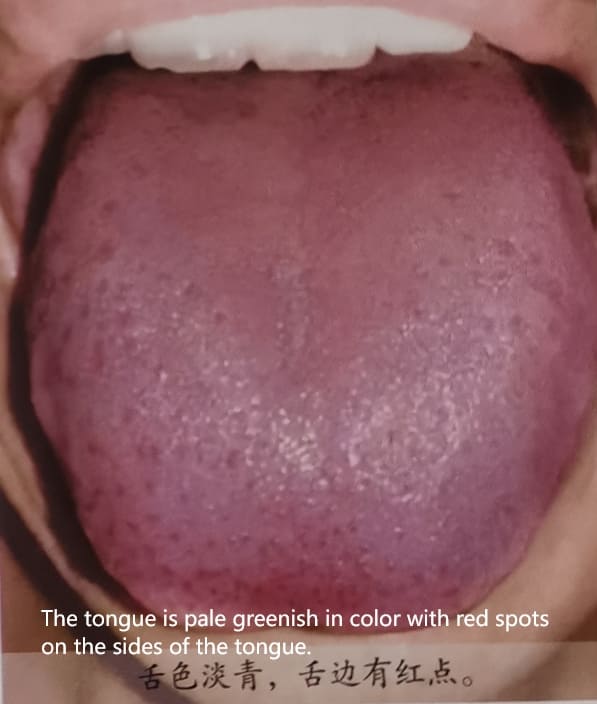 Traditional Chinese Medicine Tongue Diagnosis: How to Determine Health Through Tongue Color