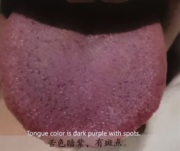 Traditional Chinese Medicine Tongue Diagnosis: How to Determine Health Through Tongue Color