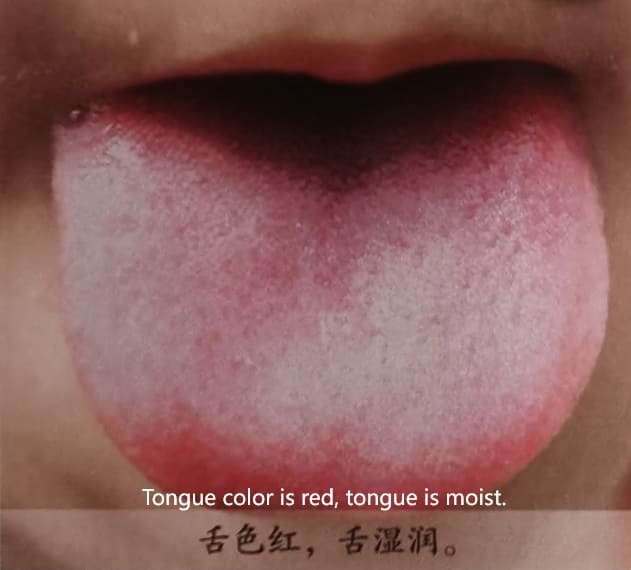 Traditional Chinese Medicine Tongue Diagnosis: How to Determine Health Through Tongue Color