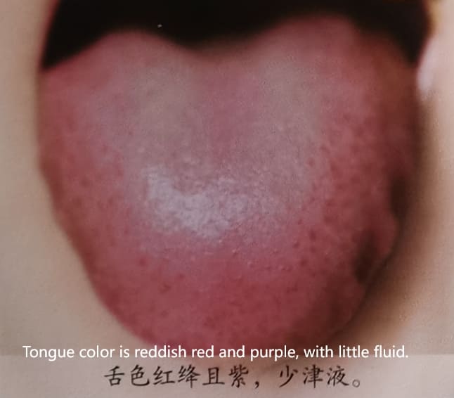 Traditional Chinese Medicine Tongue Diagnosis: How to Determine Health Through Tongue Color