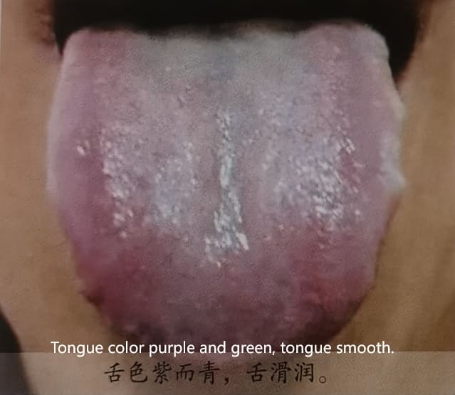 Traditional Chinese Medicine Tongue Diagnosis: How to Determine Health Through Tongue Color